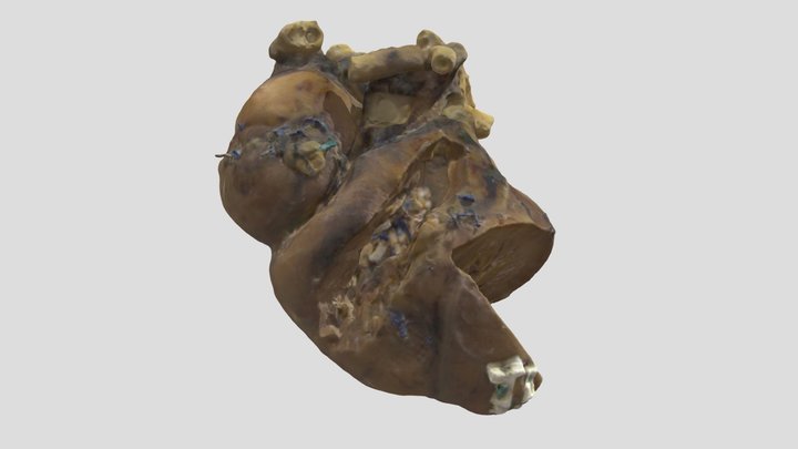 Tricuspid Atresia_A825 3D Model