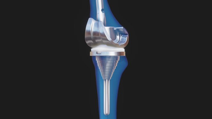 Knee  Replacement Implant 3D Model