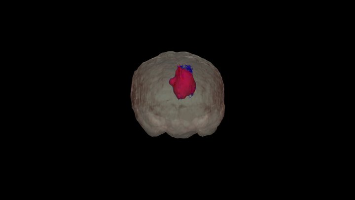 Tumor Segementation 3D Model