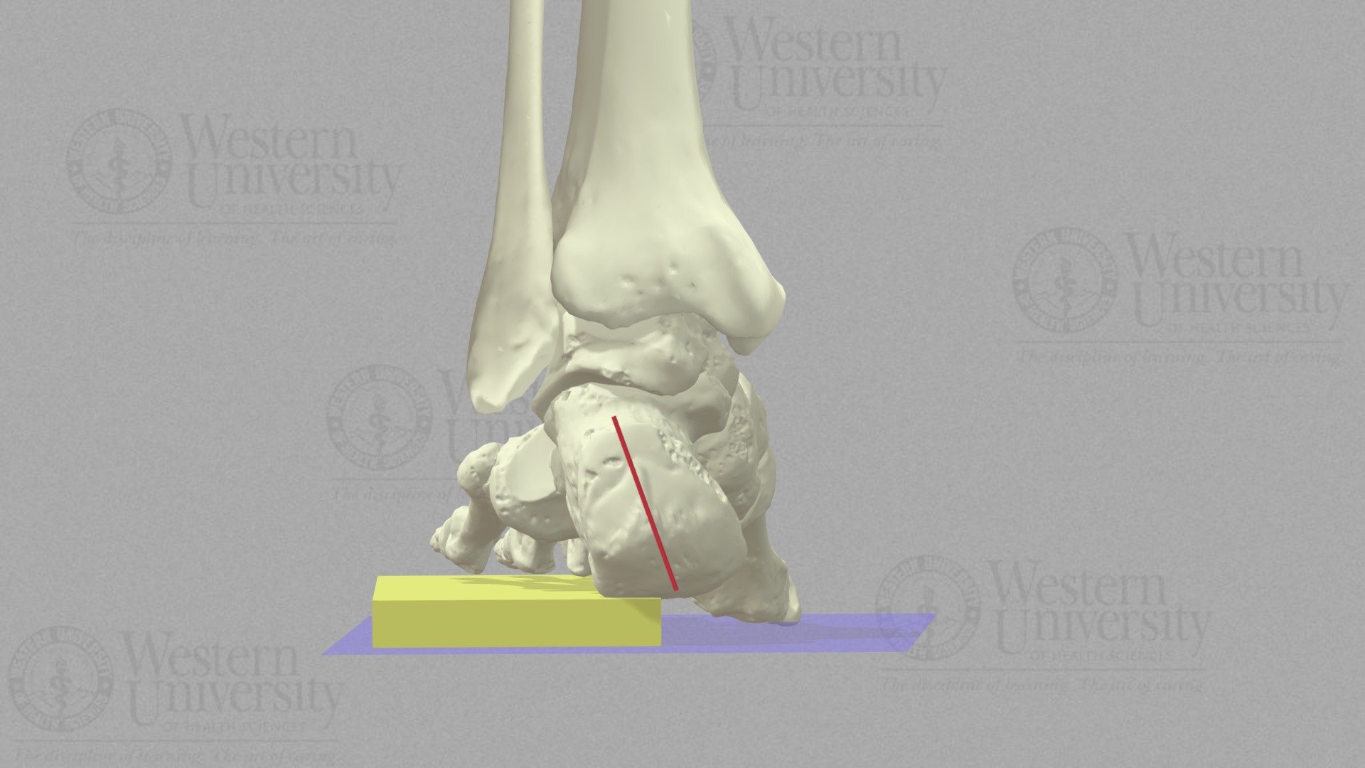 Coleman Block Test Rearfoot Driven Cavus Def. 3D model by