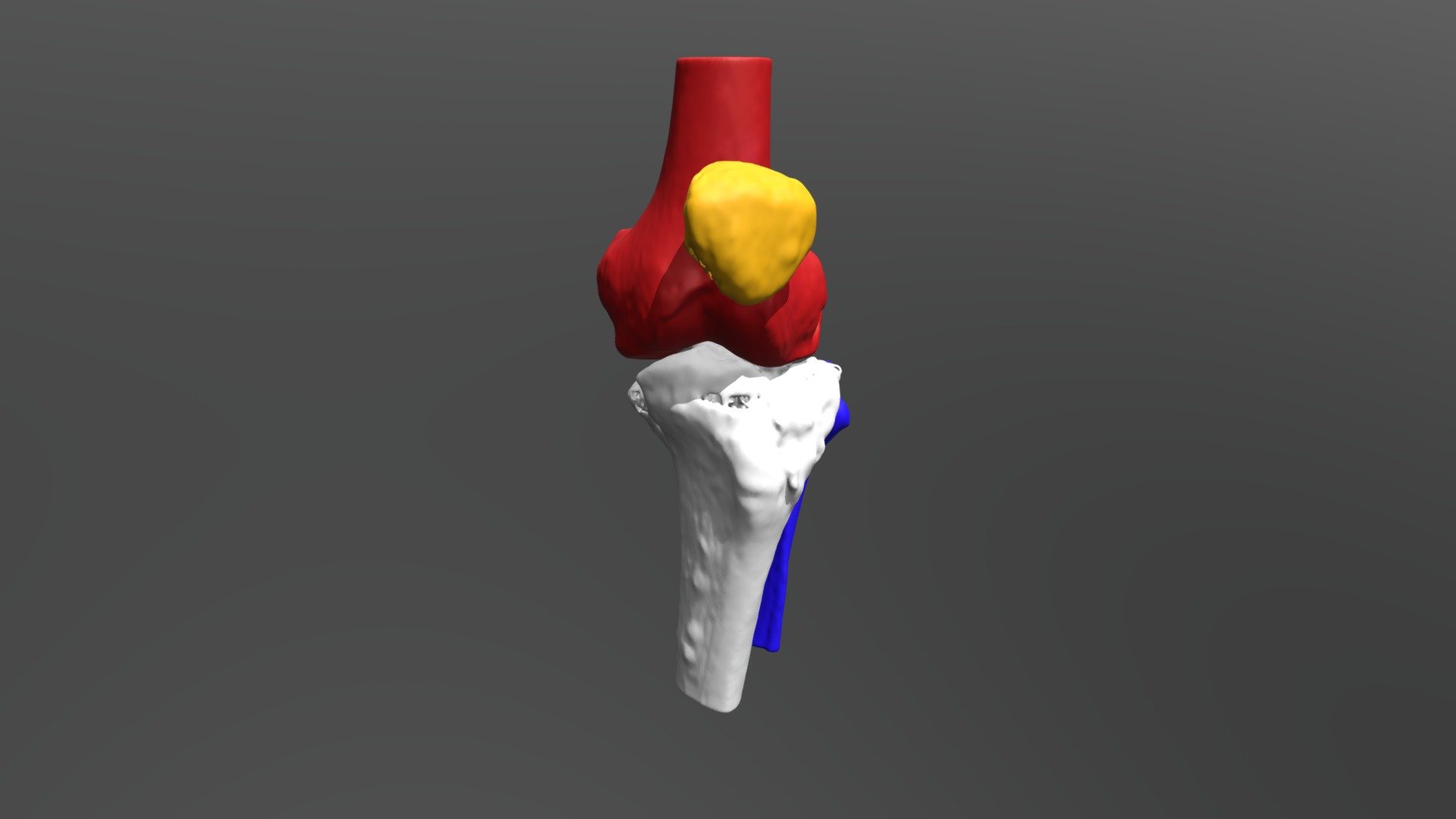 Tibia After Operation - 3D Model By Valchanov [198b3c3] - Sketchfab