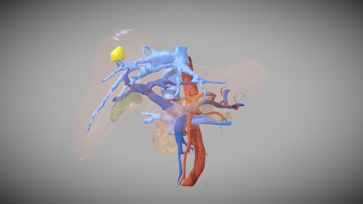 Metástasis hepática II 3D Model