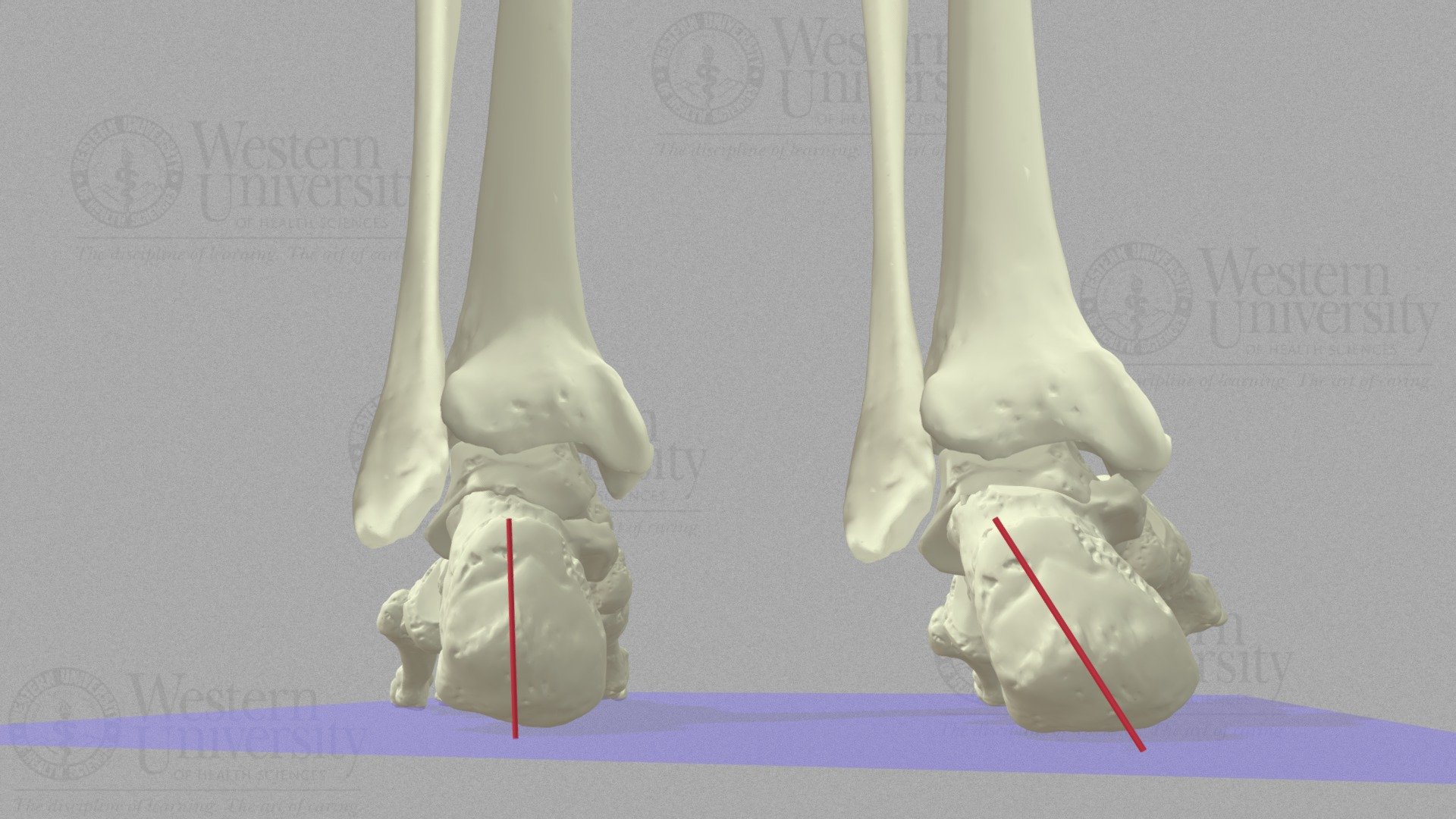 Rearfoot Varus - Early version - 3D model by WesternU3D [19cecd3 ...