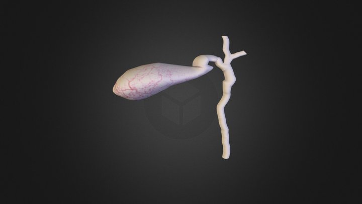High union with common hepatic duct 3D Model