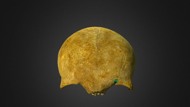 Frontal Bone