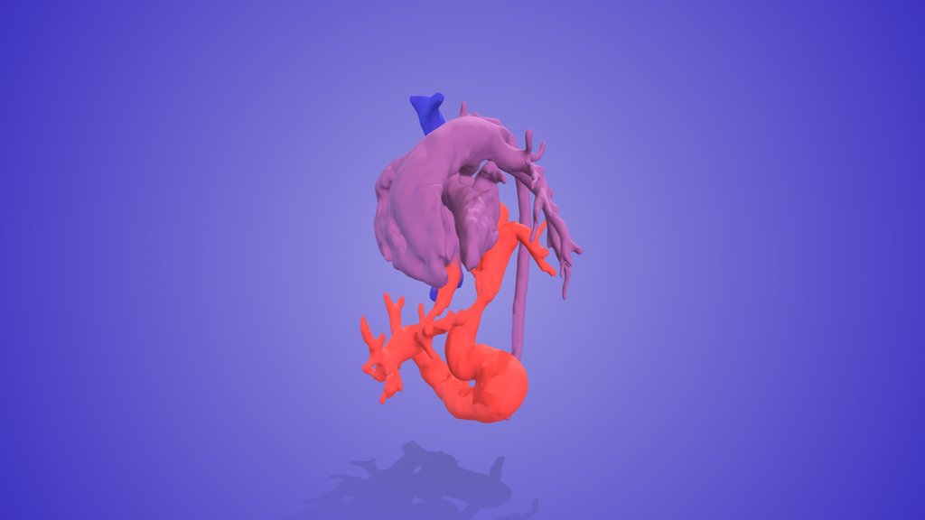 TAPVR Infracardiac