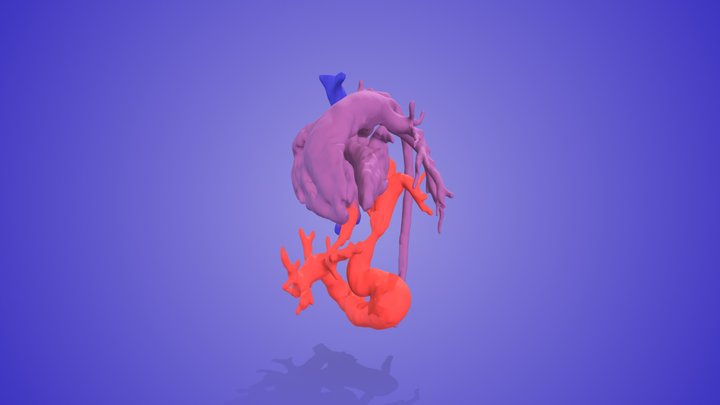 TAPVR Infracardiac – Free 3D Model STL