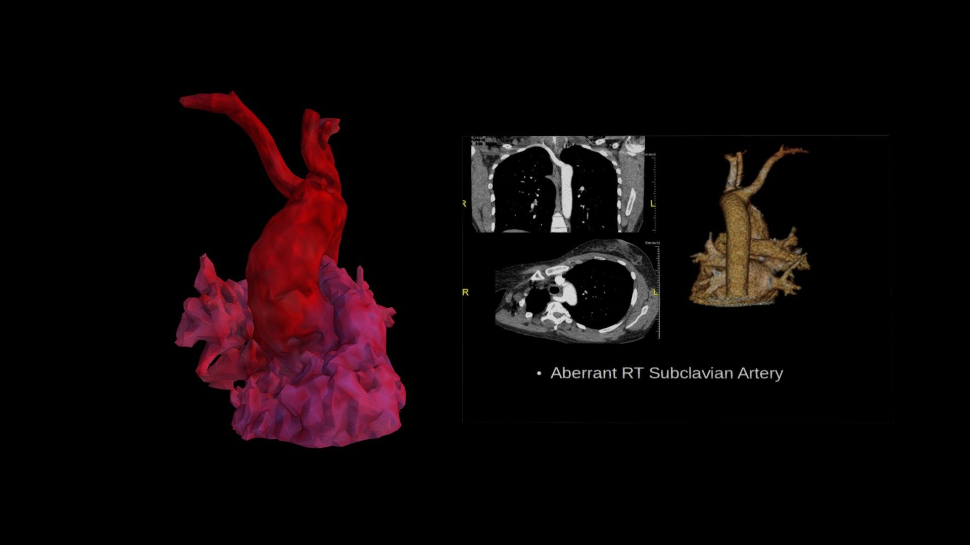Aberrant RT Subclavian Artery