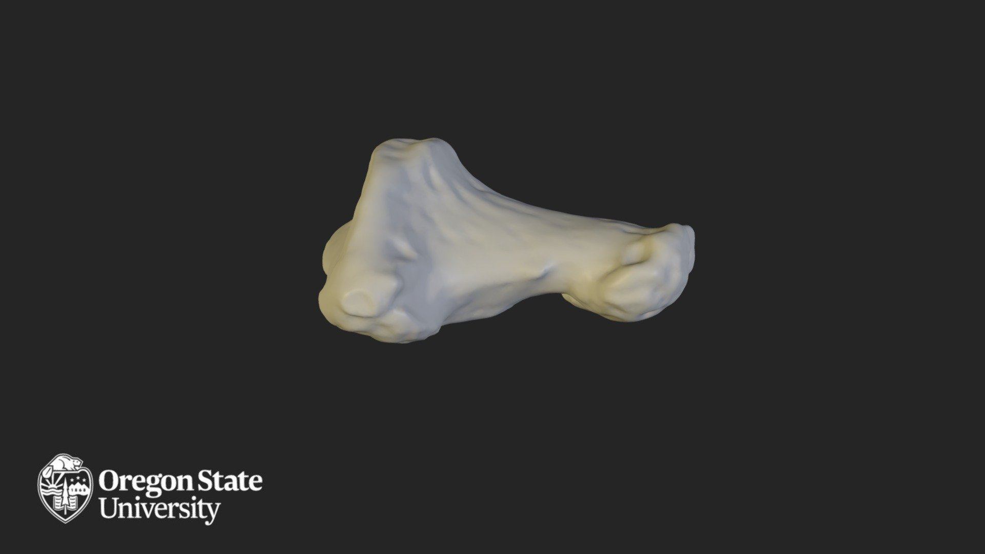 Hallux Distal 1