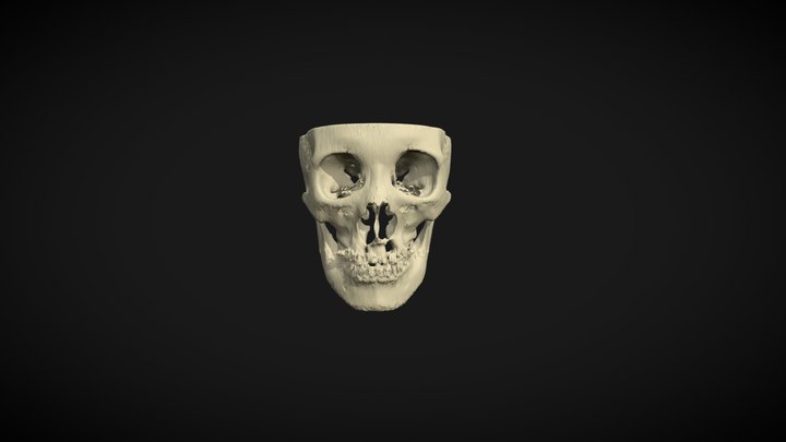 Cleft lip and palate 3D Model