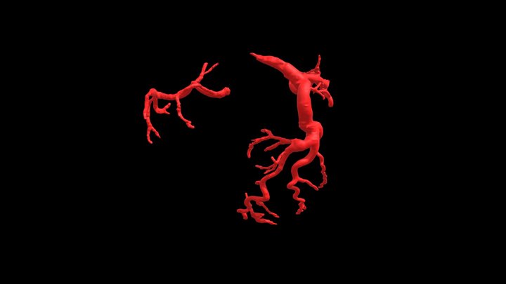 Heart0126 Coronary Arteries 3D Model