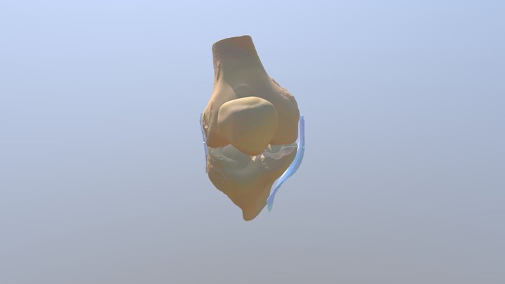 Right Knee With Torn Ligaments 3D Model