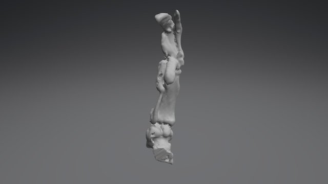 Angular Limb Deformity 3D Model