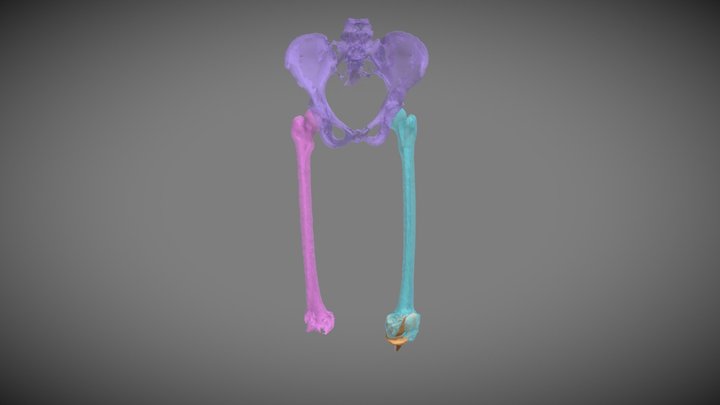 Femurs (w/implant) and Pelvis 3D Model