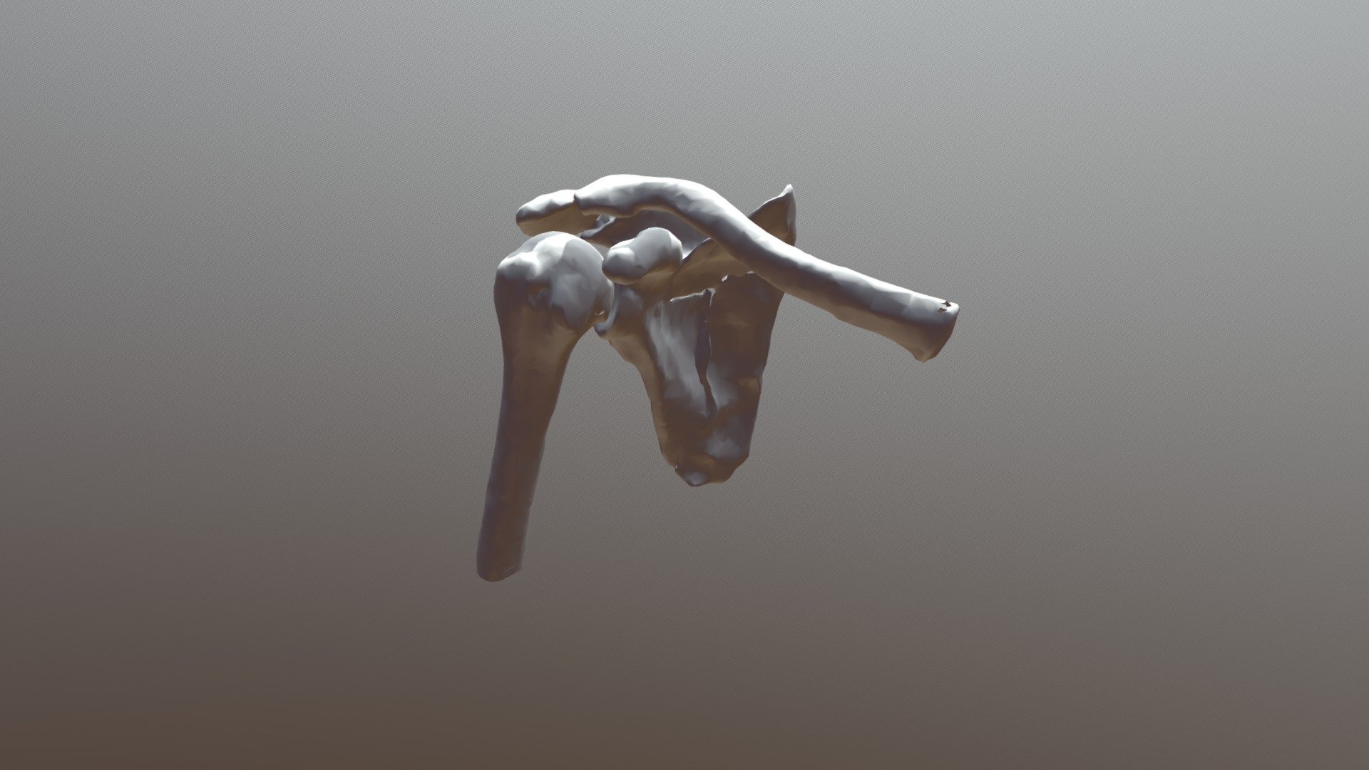Scapula/Acromium  Fracture