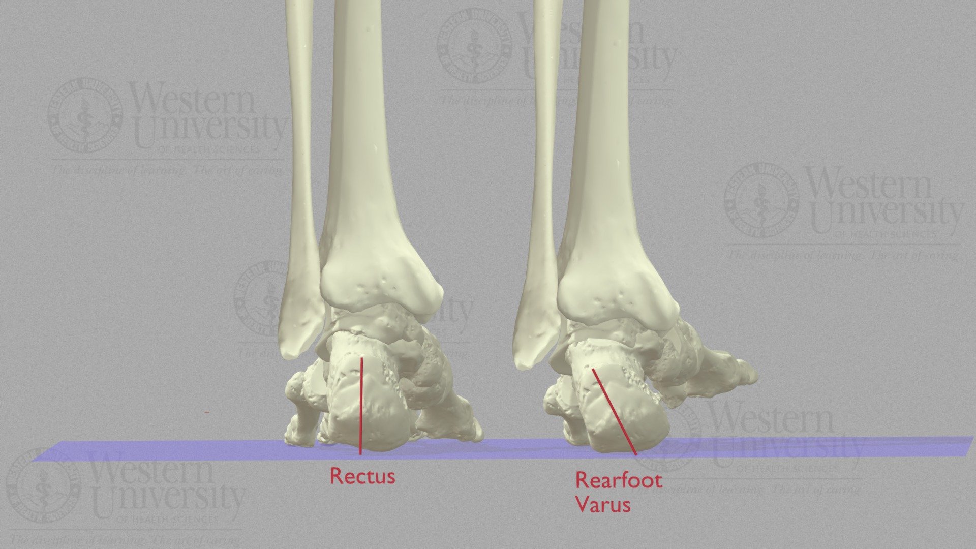 Rearfoot Varus - 3D model by WesternU3D [1e3dce0] - Sketchfab