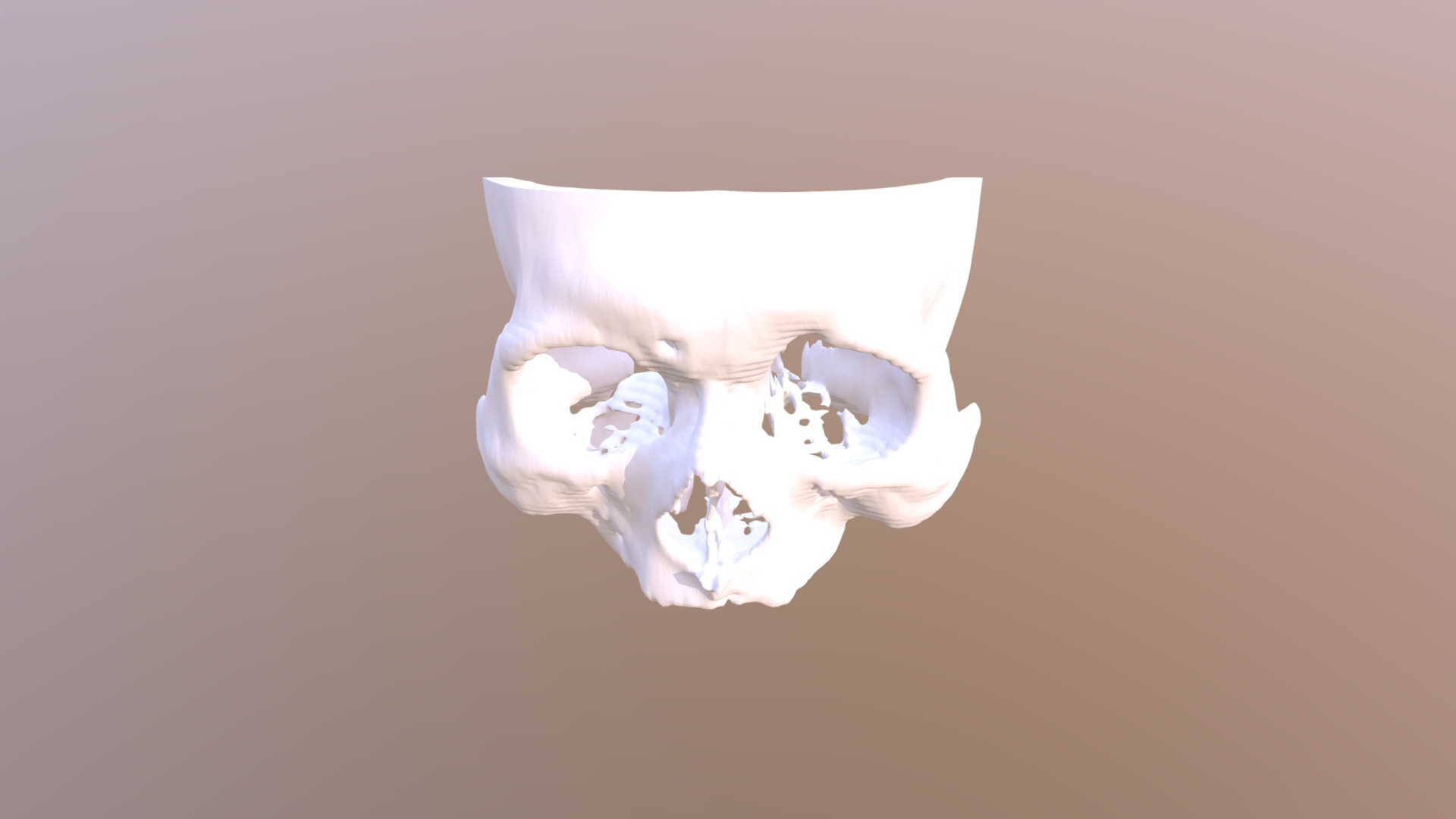 3D model Recurrent frontal sinusitis – Ant. Skull - This is a 3D model of the Recurrent frontal sinusitis - Ant. Skull. The 3D model is about a white tissue paper roll.