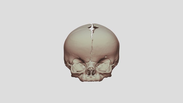 Bilateral Coronal Craniosynostosis 3D Model