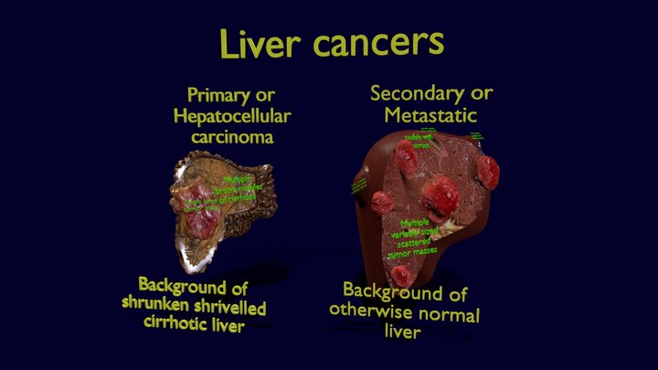 Liver Cancer Primary Metastatic 3D Model