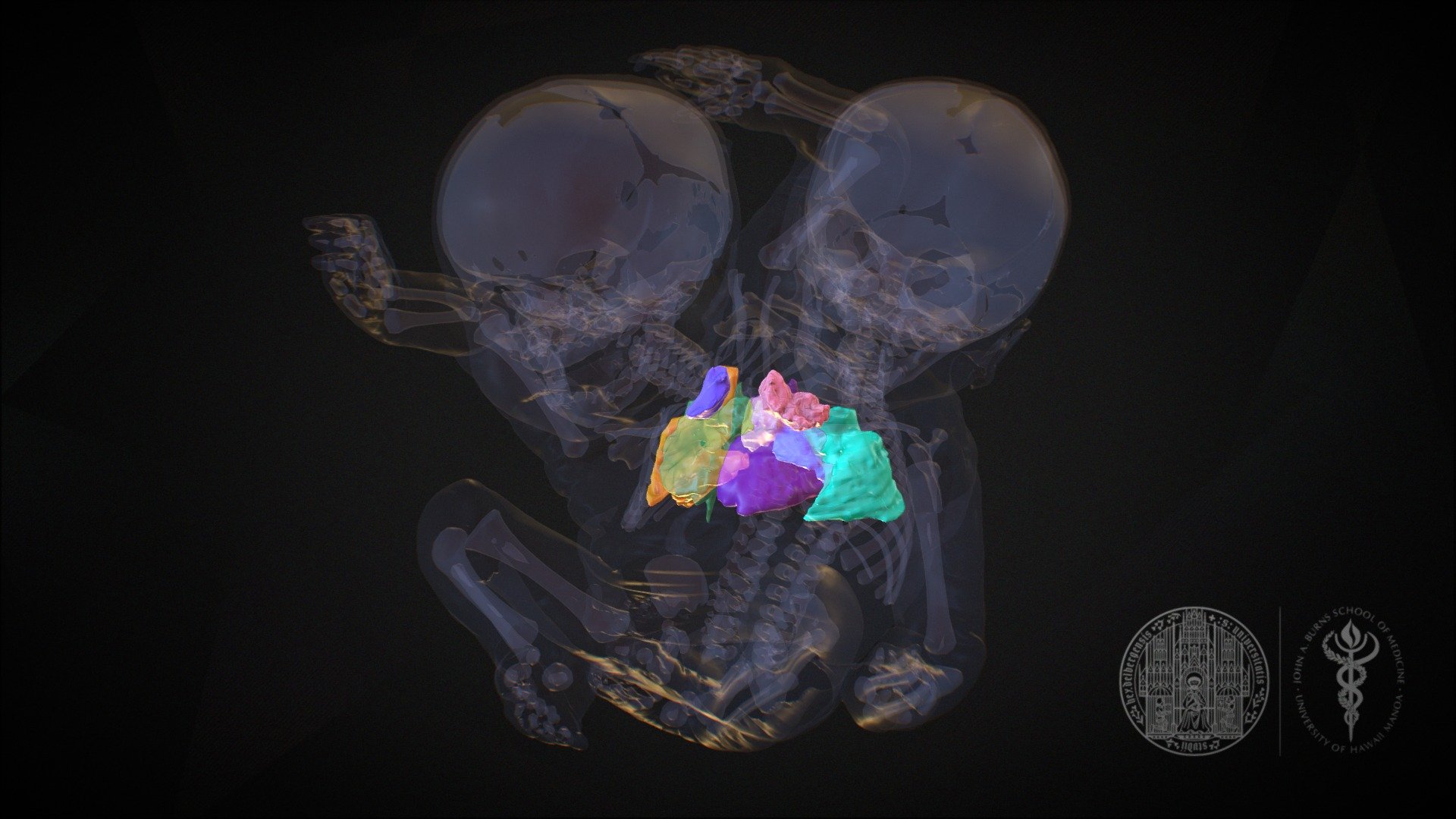 Pulmonary System - Dicephalic Parapagus Twins - 3D Model By John A ...