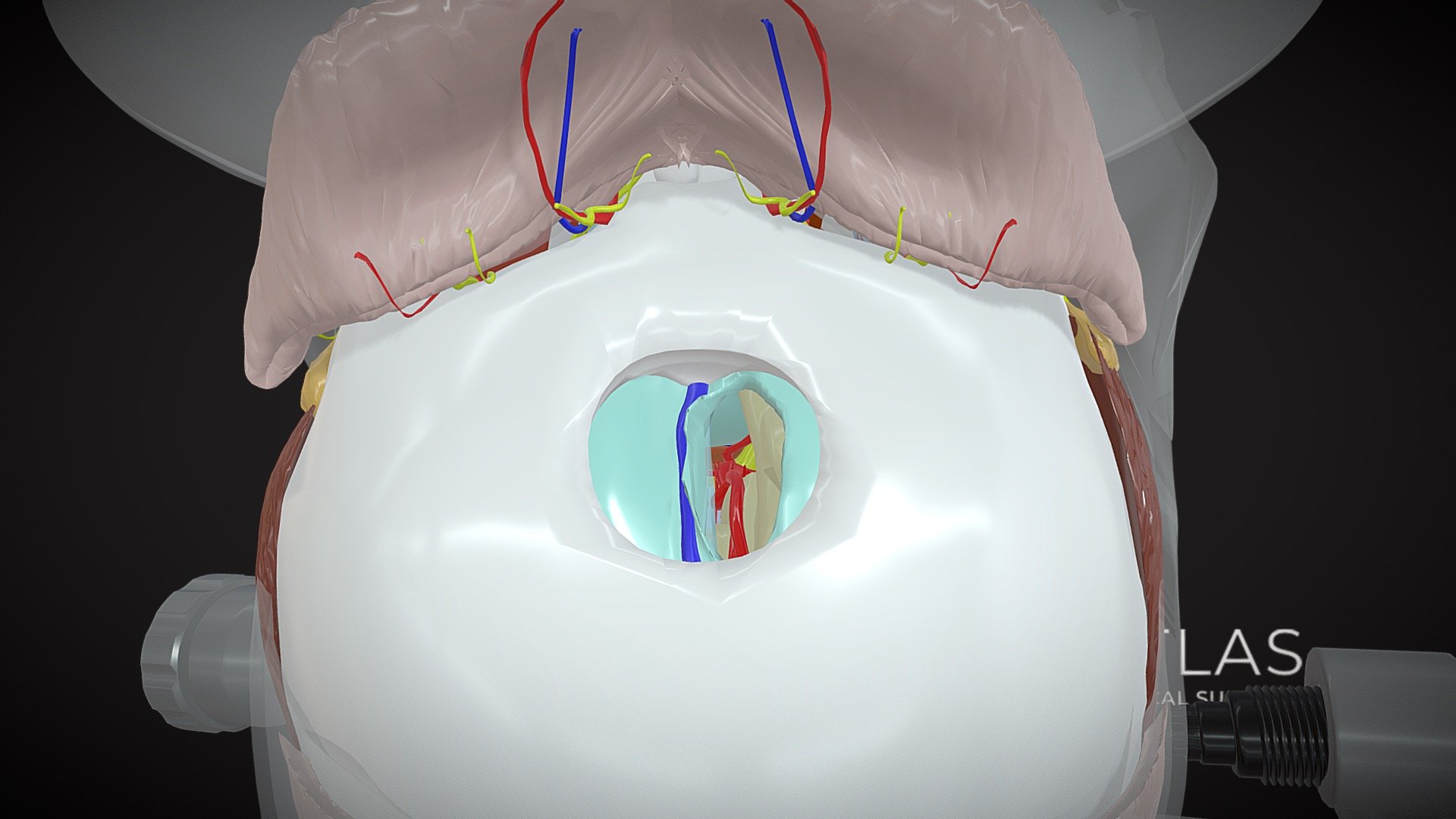 Interhemnispehric approach - unilateral - 3D model by 3D Atlas of ...