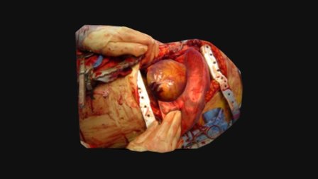 Heart Surgery 3D Model