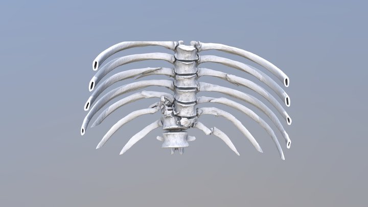 Fracture of the spine type C 3D Model