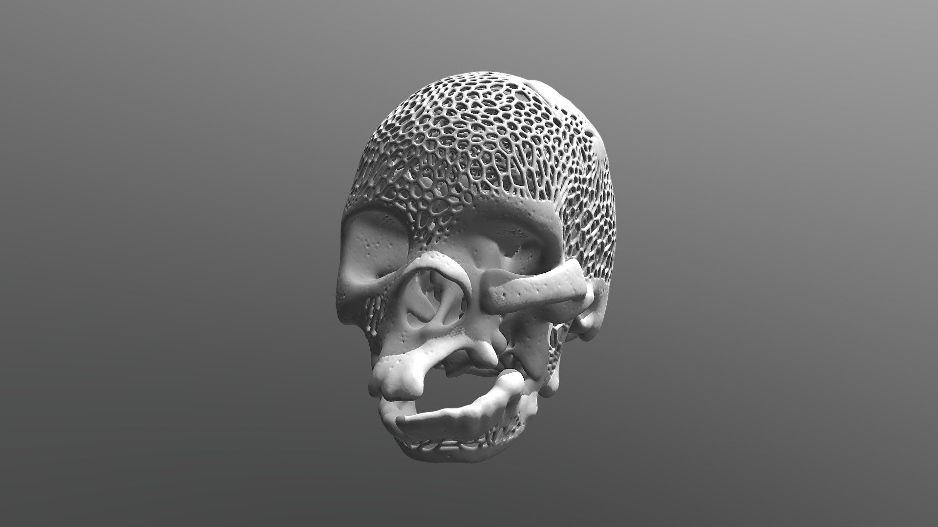 Treacher Collins syndrome malformation Voronoi