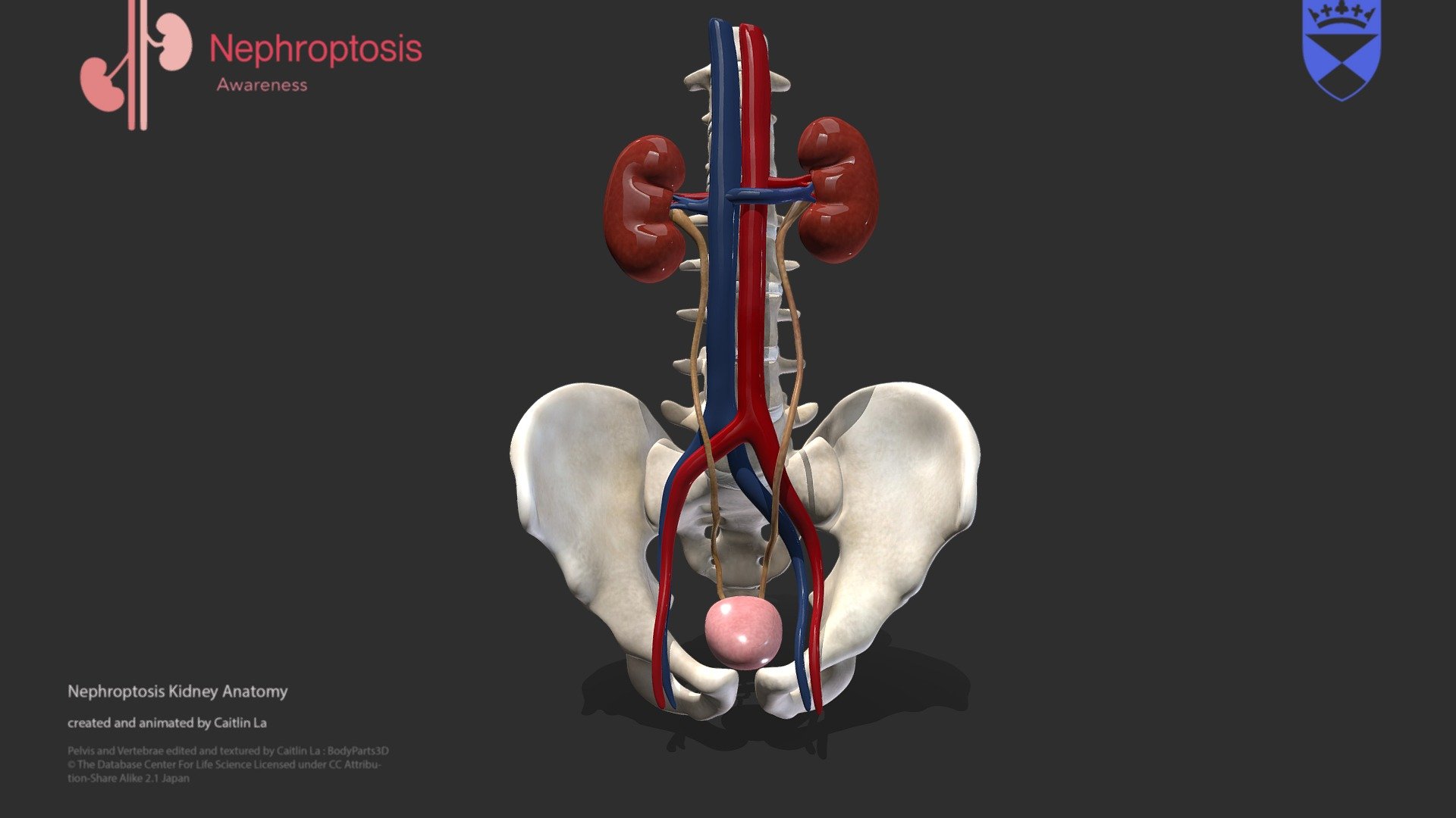 Nephroptosis Kidney Anatomy Model