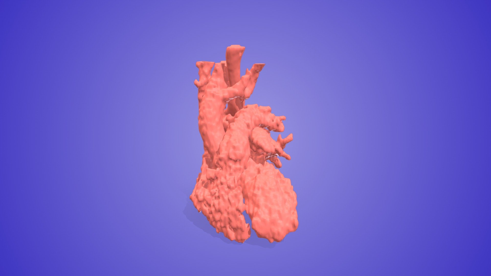 Double Aortic Arch — Sketchfab embed 3D viewer