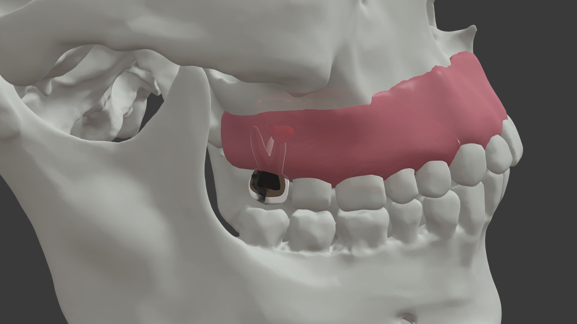 Stage 4 Short Root Maxillary Dental Infection 3d Model By University