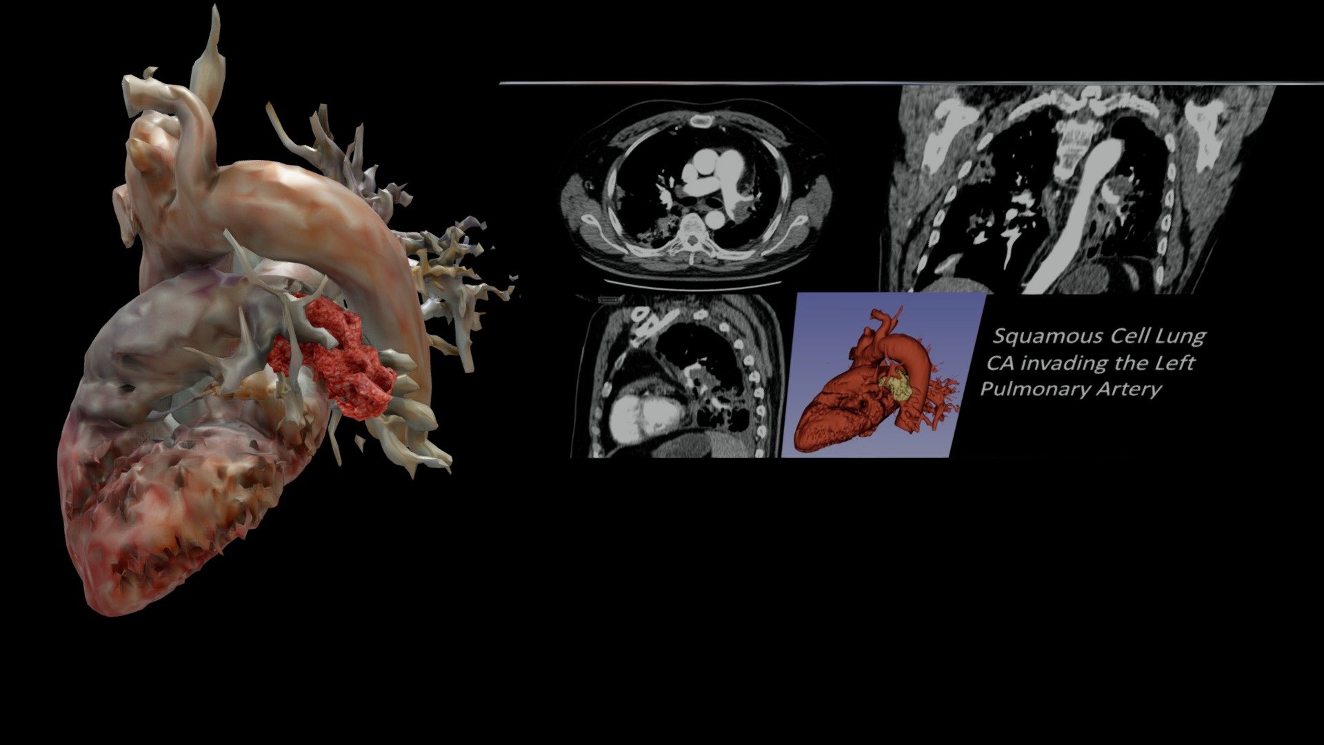 Squamous Cell CA Invading LT Pulmonary Artery