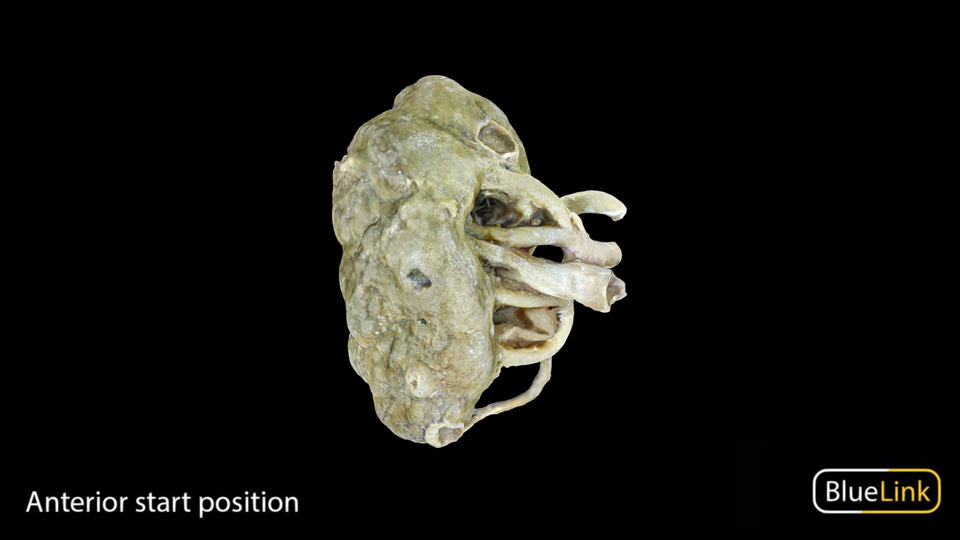 Cystic Kidney - 3D model by Bluelink Anatomy - University of Michigan ...