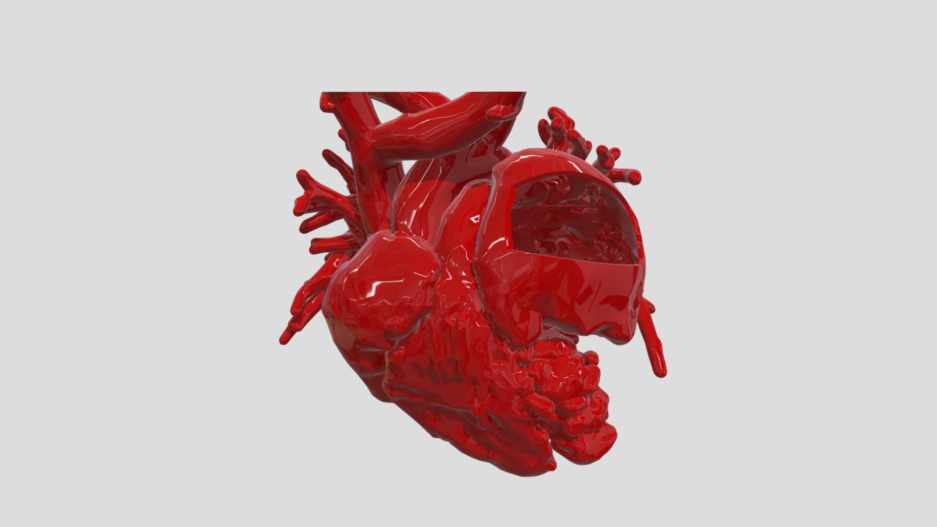 Left Atrial Appendage Aneurysm — Sketchfab embed 3D viewer