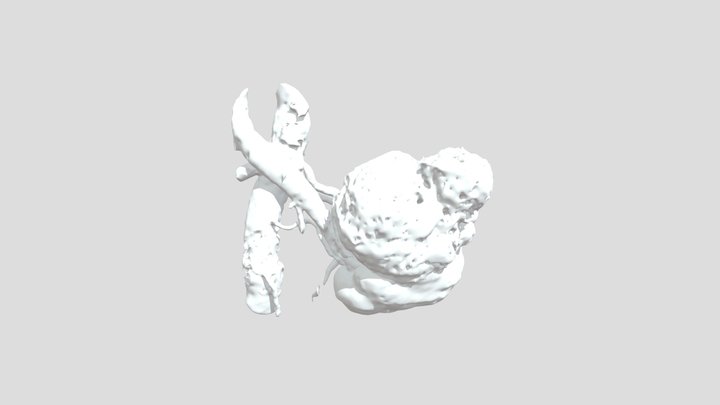 Tumornephrectomy 08/12/20 3D Model