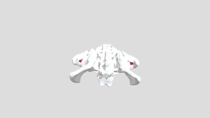 Fractura en protrusión acetabular 3D Model