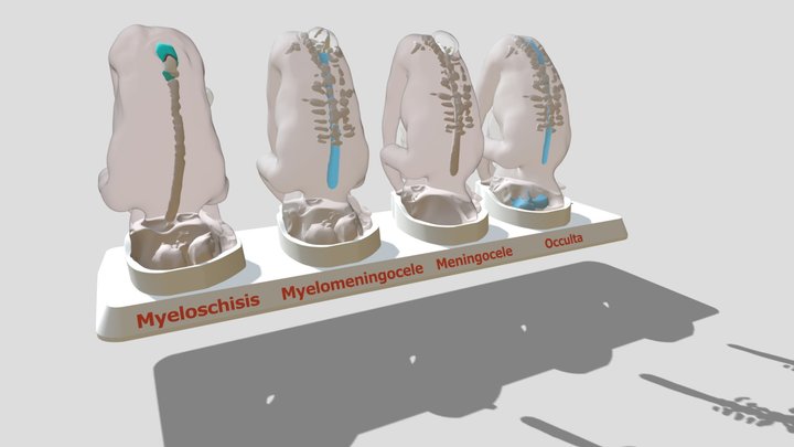 Spina Bifida Examples 3D Model