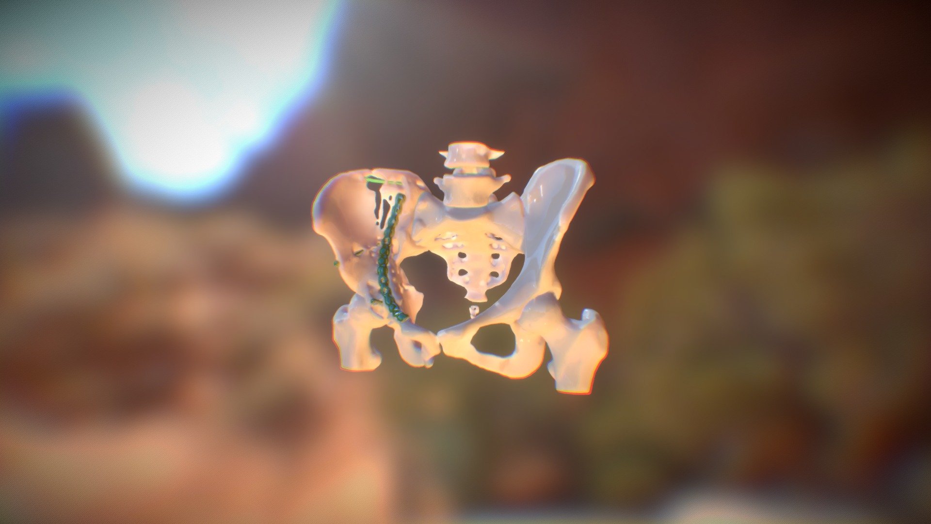 Pelvis Fracture Exam 3