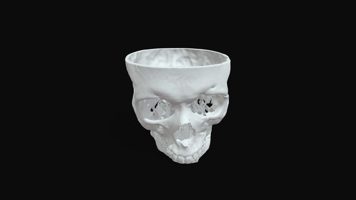 Tomografia craneo senos nasales con fractura 3D Model