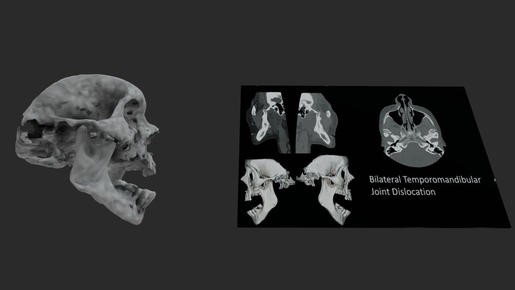 TMJ - A 3D model collection by grinakan96 - Sketchfab