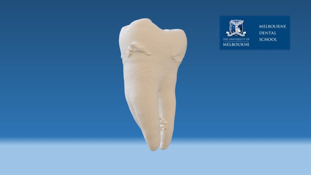 Permanent mandibular molar with wear.