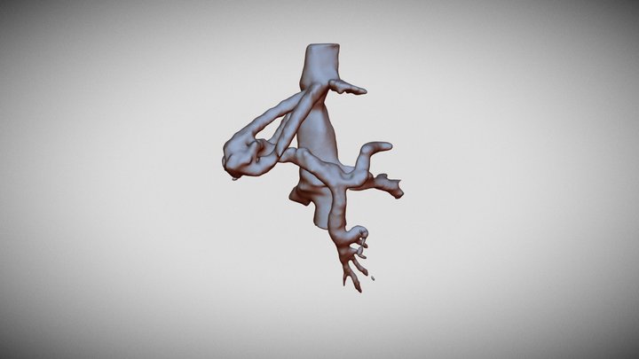 Congenital intrahepatic portosystemic shunt 3D Model