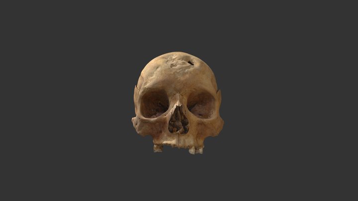 Skull showing treponemal disease (syphilis) 3D Model
