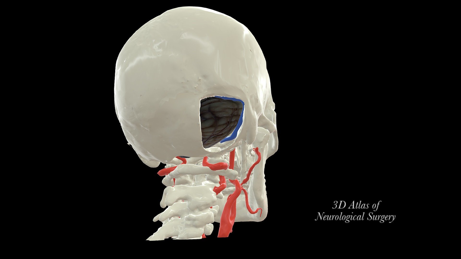Retrosigmoid Craniectomy Simulation 3d Model By 3d Atlas Of Neurological Surgery Tspiriev 3243
