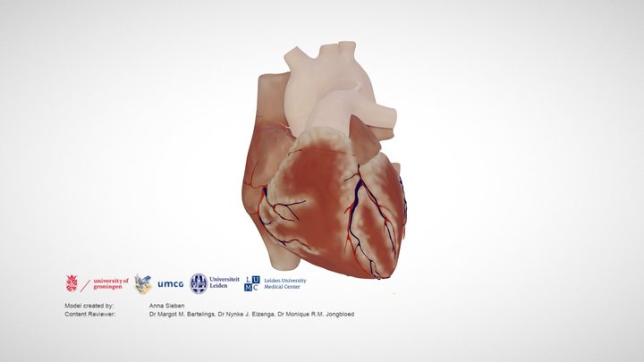 Atrioventricular septal defect – Modello 3D gratuito STL