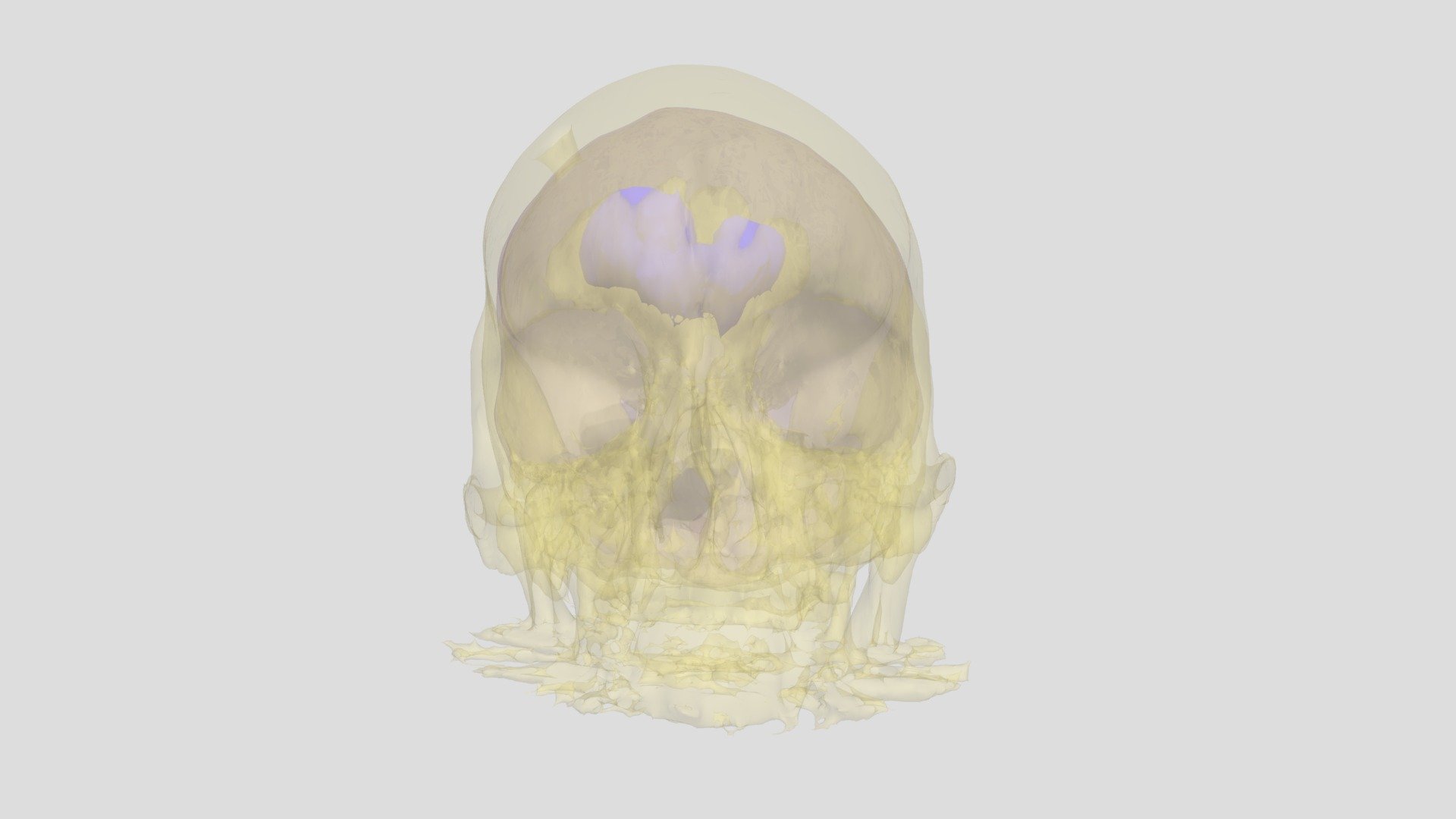 3D Models of a CT Brain with Tumor