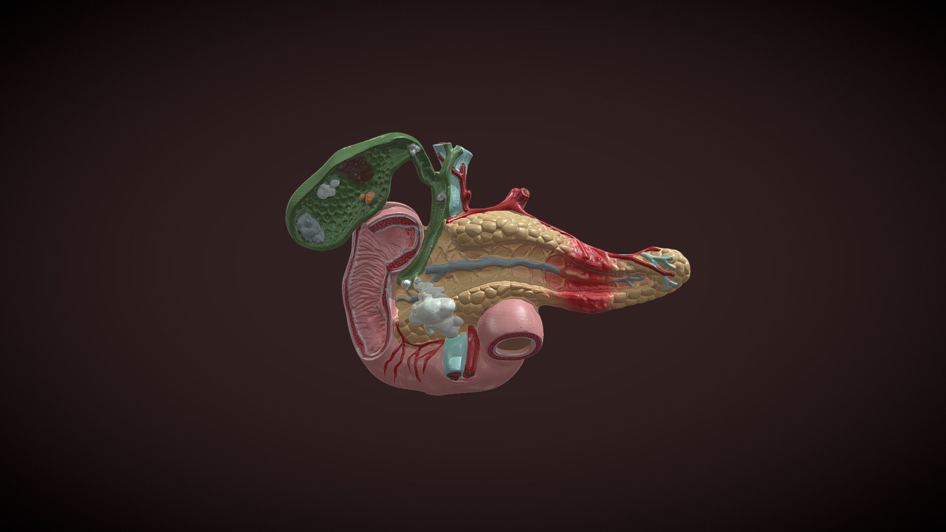 Diseased Gallbladder and Pancreas - 3D model by OrJames Labs ...
