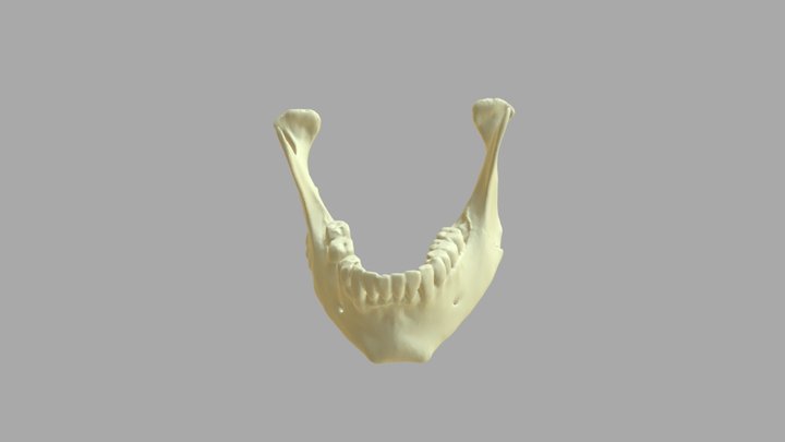 Mandible fracture: Body 3D Model