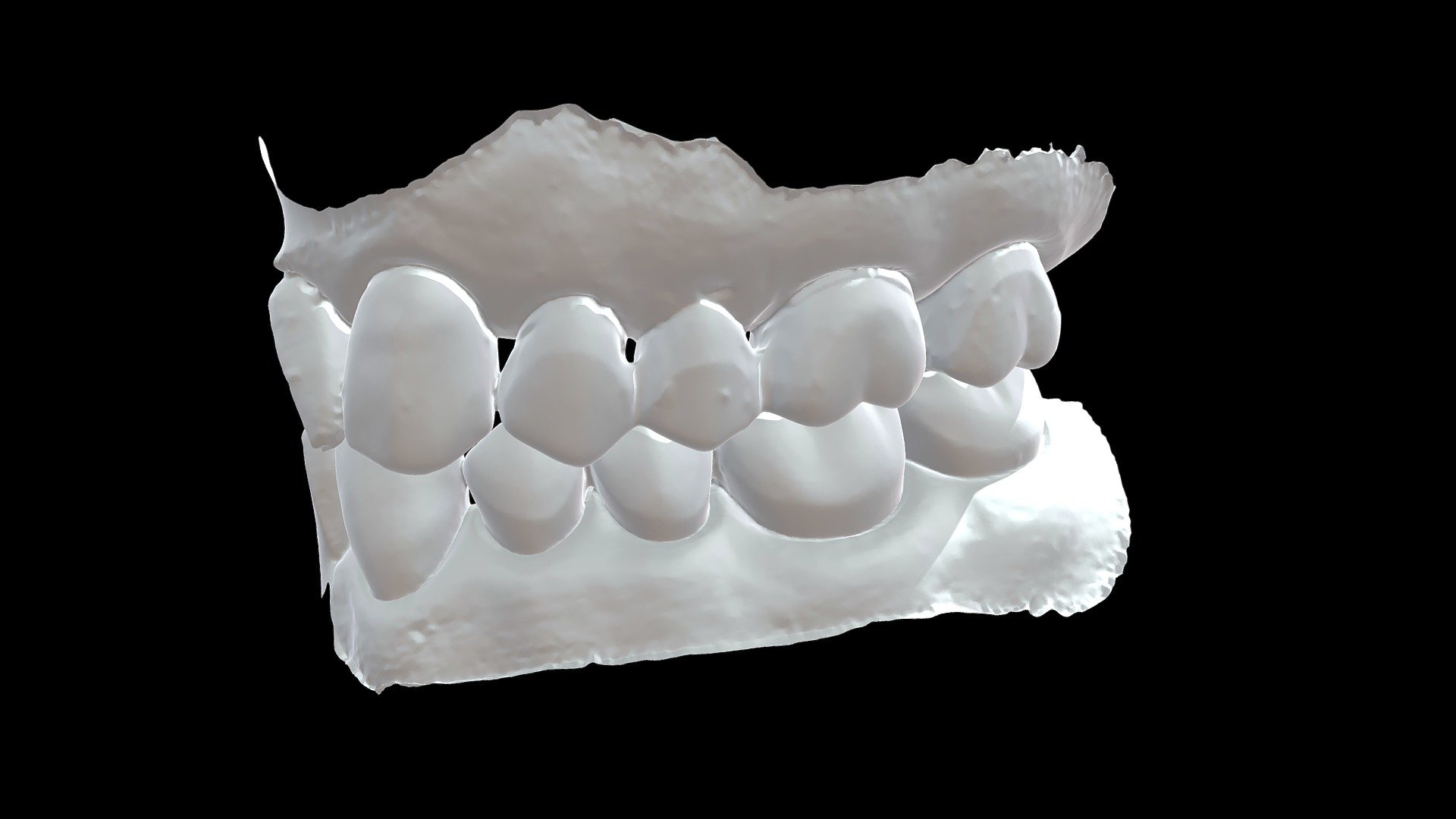 #12-14 FPD Provisional Articulated - Download Free 3D model by bchui ...