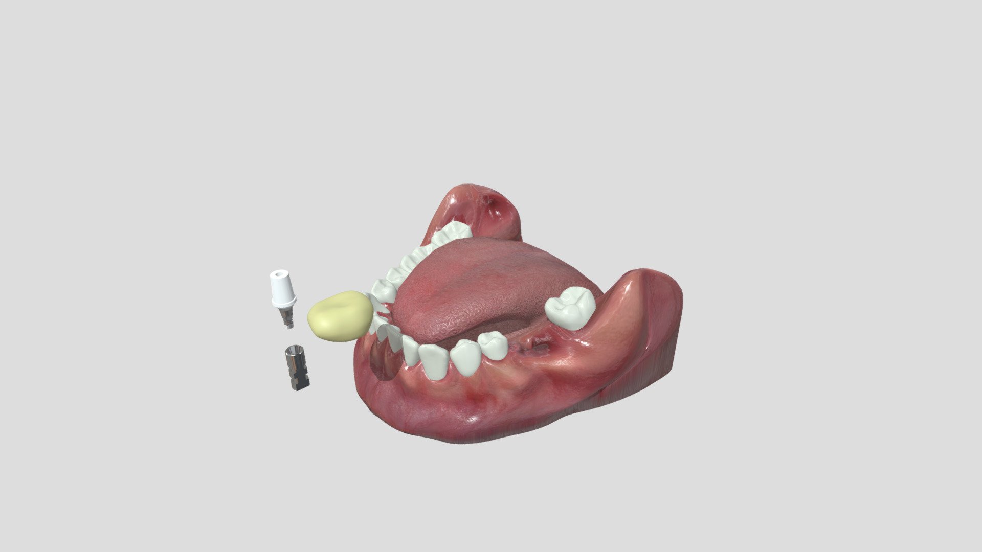 Temporary crown on implant PEEK 3D model by Mateus Bertolini